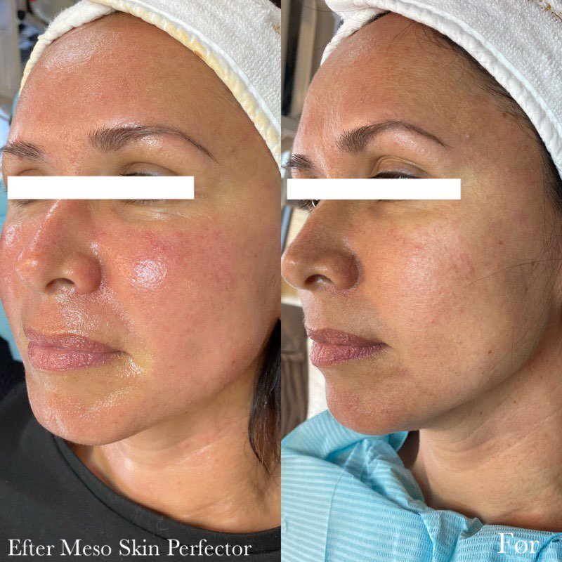 Før og efter hudplejebehandling hos Chika Beauty – billede 1