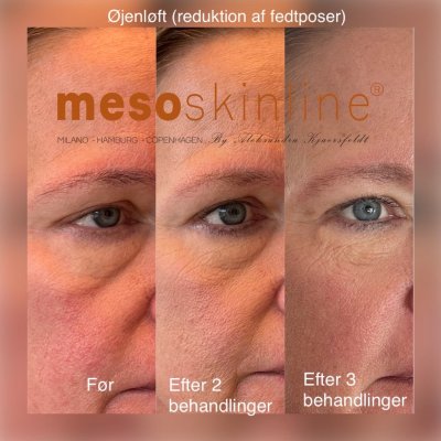 Før og efter hudplejebehandling hos Chika Beauty – billede 4