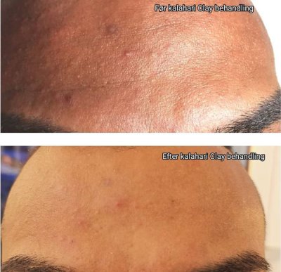 Før og efter hudplejebehandling hos Chika Beauty – billede 5