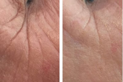 Før og efter hudplejebehandling hos Chika Beauty – billede 7