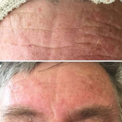 Før og efter hudplejebehandling hos Chika Beauty – billede 6