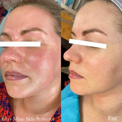 Før og efter hudplejebehandling hos Chika Beauty – billede 3