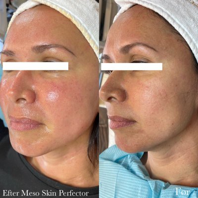Før og efter hudplejebehandling hos Chika Beauty – billede 1