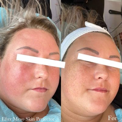 Før og efter hudplejebehandling hos Chika Beauty – billede 2